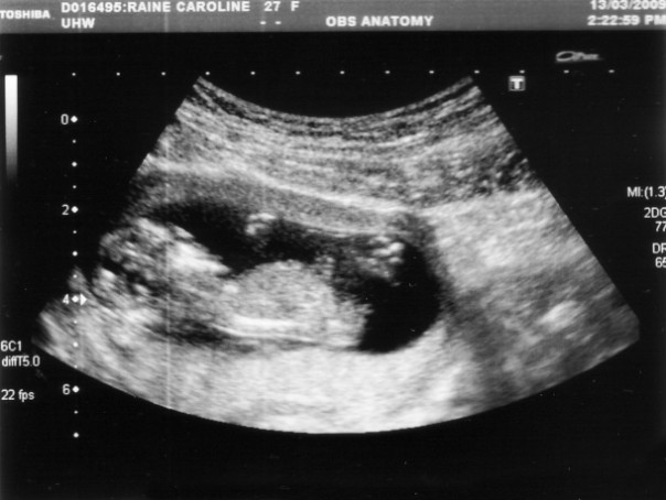 The Abortion Debate